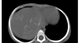 Đặc điểm hình ảnh của u nguyên bào gan trẻ em trên phim chụp cắt lớp vi tính hai dãy đầu thu 