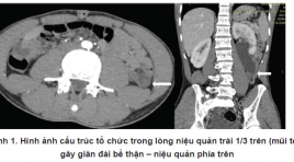 Polyp niệu quản lành tính gây tắc nghẽn đường bài tiết cao: Báo cáo trường hợp case lâm sàng tại bệnh viện Việt Đức