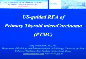 RFA of papillary thyroid microcarcinoma