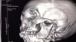 So sánh khả năng phát hiện và phân loại tổn thương gãy xương tầng giữa mặt của Xquang thường quy với chụp cắt lớp vi tính