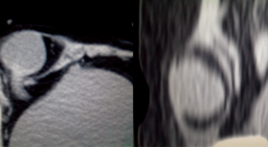 Hình ảnh siêu âm và chụp cắt lớp vi tính nang ống Nuck nhân một trường hợp