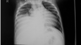 Nhân một trương hợp tràn dịch màng phổi trong bệnh cảnh xơ gan ở trẻ em