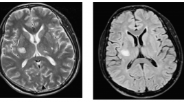 Nghiên cứu đặc điểm hình ảnh cộng hưởng từ chảy máu nhu mô não không do chấn thương