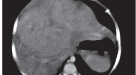 Gía trị của chụp cắt lớp vi tính hai dãy đầu thu trong chẩn đoán u nguyên bào gan trẻ em
