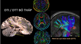 MRI khuếch tán theo hướng và bó sợi thần kinh (DTI/DTT)