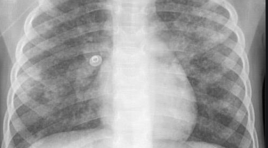 Chẩn đoán hình ảnh lao phổi trẻ em