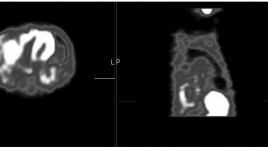 Ghi hình phóng xạ 99mTc-MIBI đánh giá đáp ứng với xạ trị ở bệnh nhân ung thư phổi không tế bào nhỏ