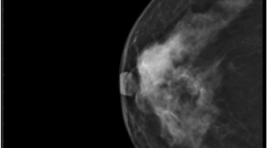 Gía trị của cắt lớp tuyến vú kỉ thuật số ( DBT) trong chẩn đoán ung thư vú