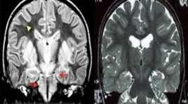 Báo cáo ca bệnh MSUD - Khuyến cáo chỉ định chụp MRI trong cấp cứu sơ sinh