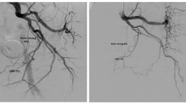 Nghiên cứu đặc điểm giải phẫu, biến thể của động mạch tuyến tiền liệt trên chụp mạch số hóa xóa nền 