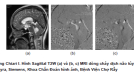 Ứng dụng lâm sàng kỹ thuật cộng hưởng từ tương phản pha (PC-MRI) trong đánh giá động học dòng chảy dịch não tủy