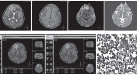 Giá trị của CHT khuếch tán trong chẩn đoán phân  biệt áp xe não và u não hoại tử hoặc u não dạng  nang 