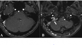 Vai trò của chuỗi xung 3D TOF MRA trong đánh giá rò động tĩnh mạch màng cứng nội sọ