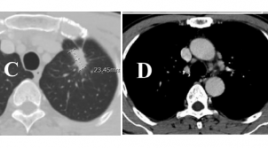 Đặc điểm hình ảnh cắt lớp vi tính 256 dãy trong chẩn đoán và theo dõi điều trị ung thư phổi biểu mô tuyến có đột biến EGFR