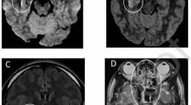 Báo cáo ca đầu tiên viêm não, màng não liên quan đến SARS-CoV-2