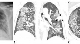 Hình ảnh X-quang (XQ) và cắt lớp vi tính (CLVT) của viêm phổi do siêu vi Corona chủng mới 2019 (COVID-19): phân tích trên 9 bệnh nhân tại Hàn Quốc