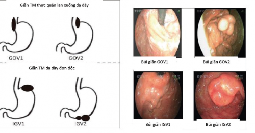 Các nguyên nhân gây bệnh tĩnh mạch dạ dày và phương pháp điều trị