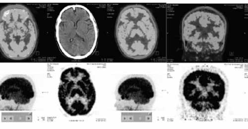 Có những loại xét nghiệm nào để phát hiện và chẩn đoán bệnh Alzheimer?
