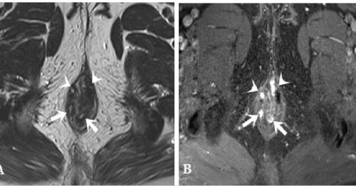 Đặc điểm hình ảnh cộng hưởng từ của rò hậu môn | Hội Điện Quang và ...