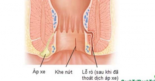 Bệnh Crohn có thể chữa khỏi không? 
